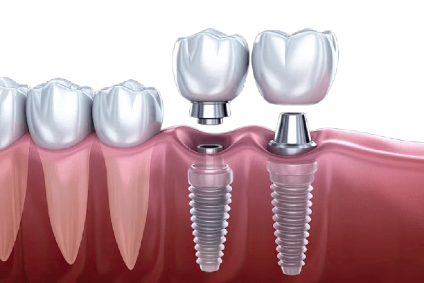 Dental Implants